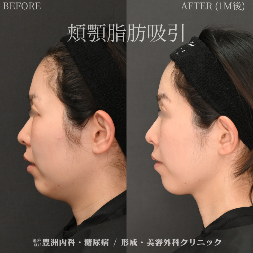 頬顎脂肪吸引 / 30代女性